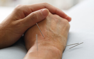 acupuncture for pain