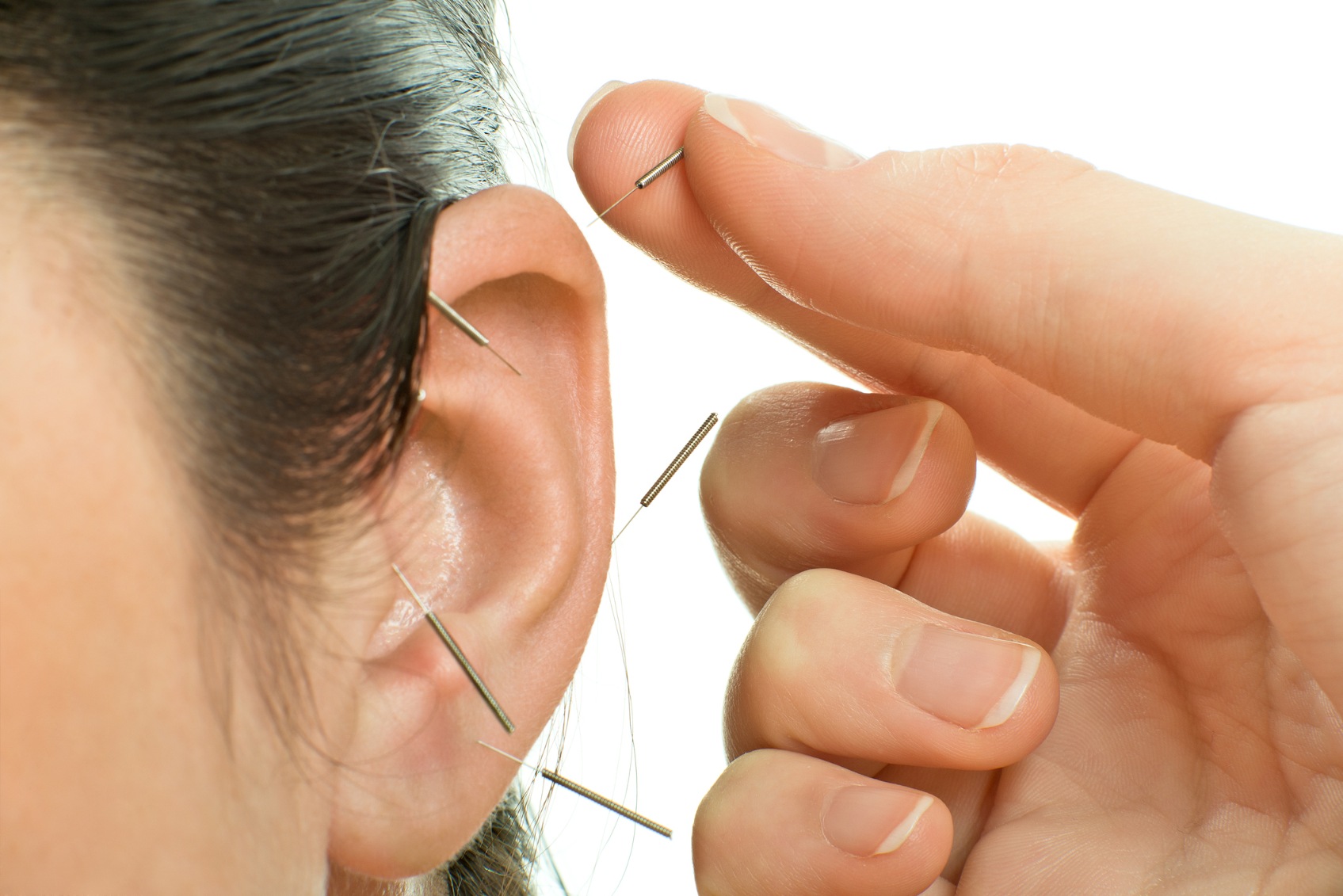 hand inserting acupuncture needles into ear