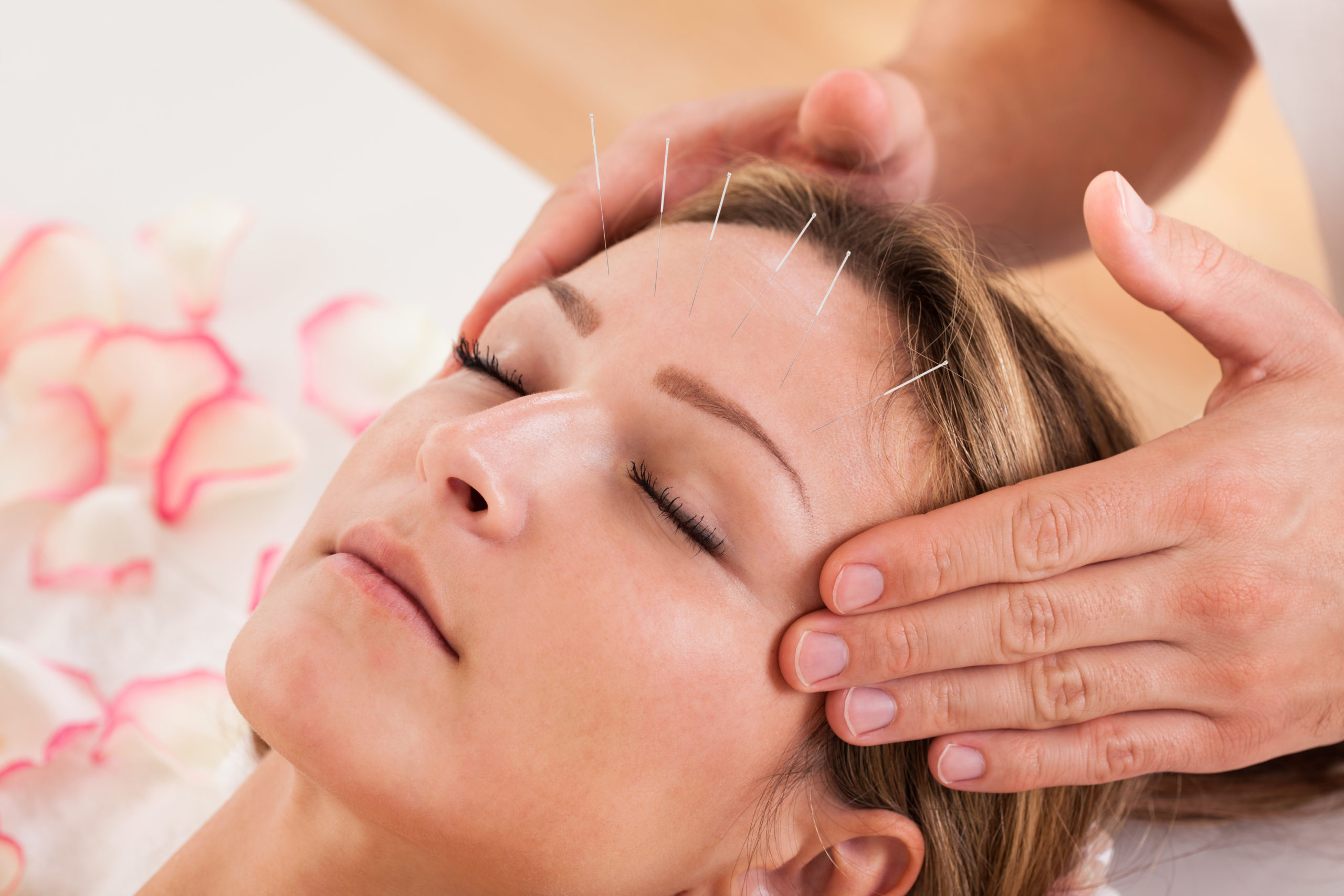 Woman undergoing acupuncture treatment and a massage