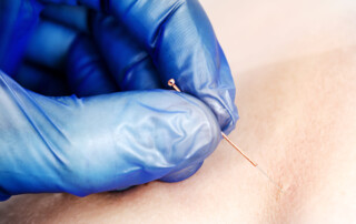Needle and hands of physiotherapist doing a dry needling