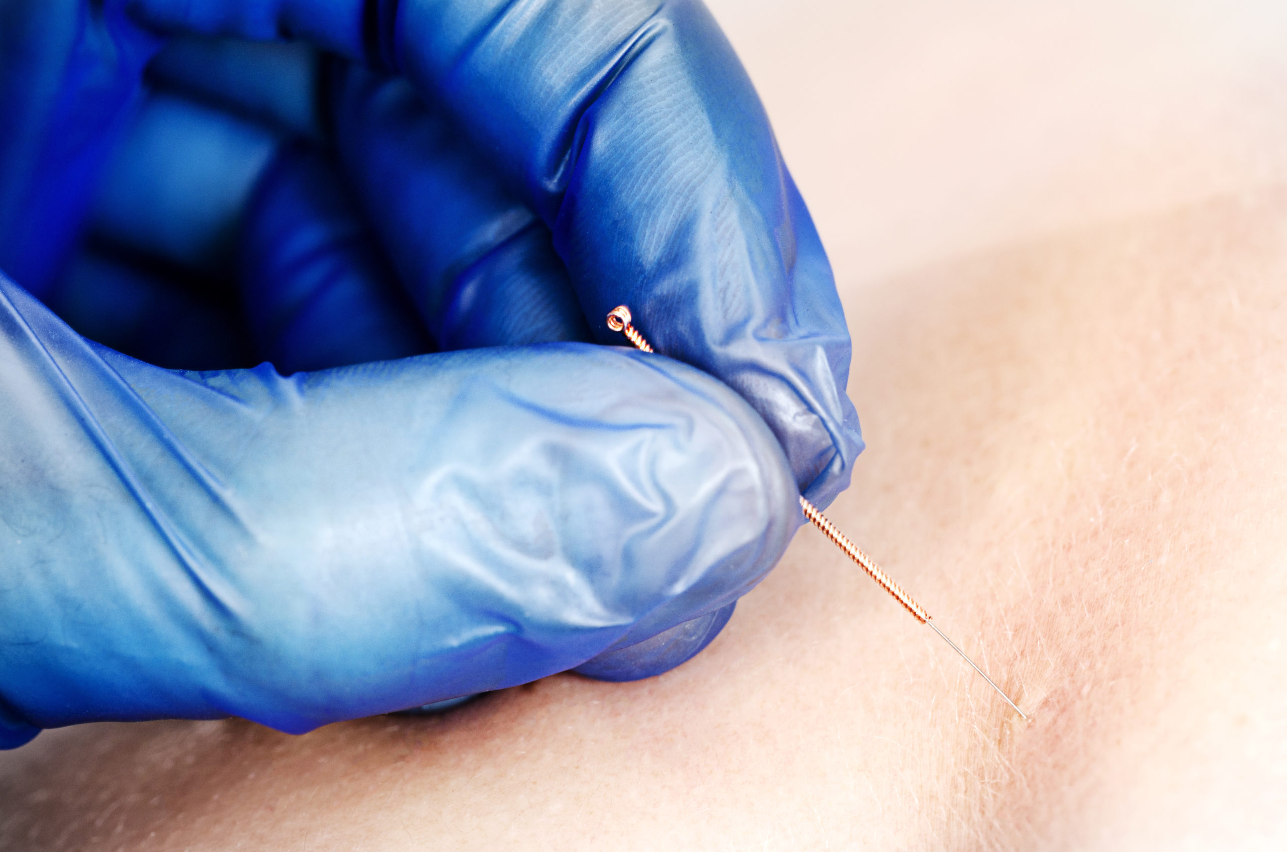 Needle and hands of physiotherapist doing a dry needling