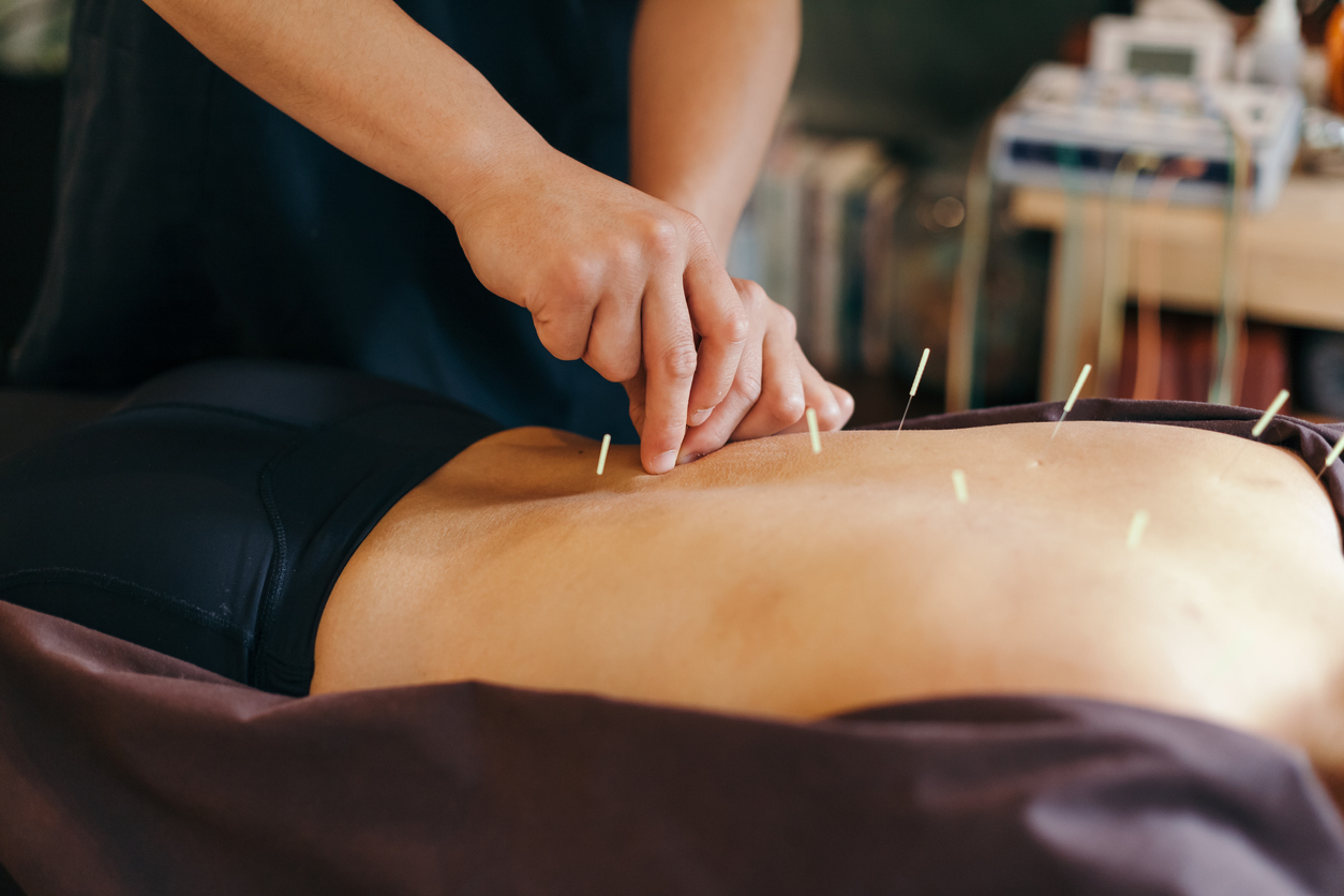 a person getting acupuncture in her back